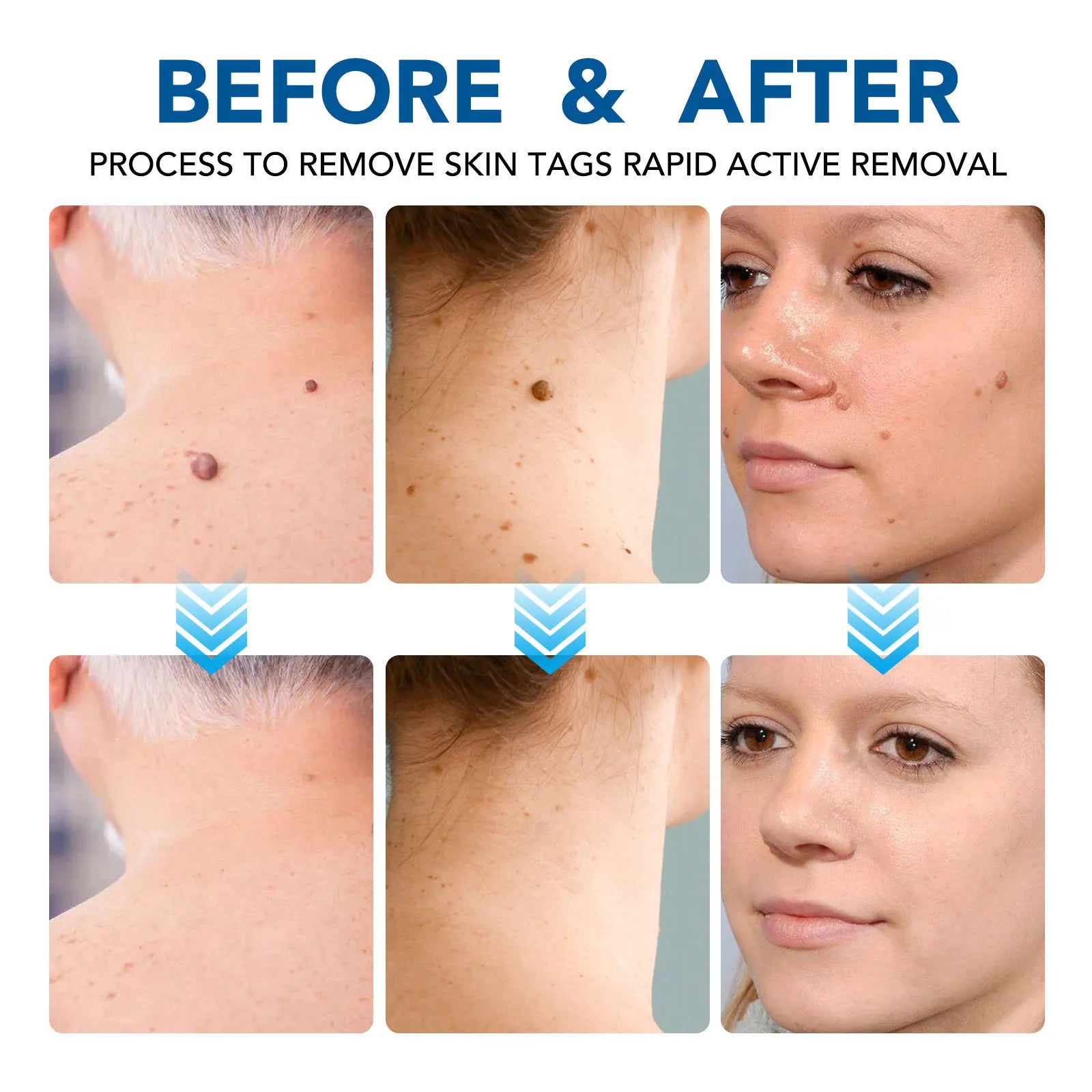 Home Use Painless Safe Skin Tag Mole Wart Spot Removal Equipment for Smooth Skin Wart Remover Eyelid Lifting Acne Treatment Pen - Ammpoure