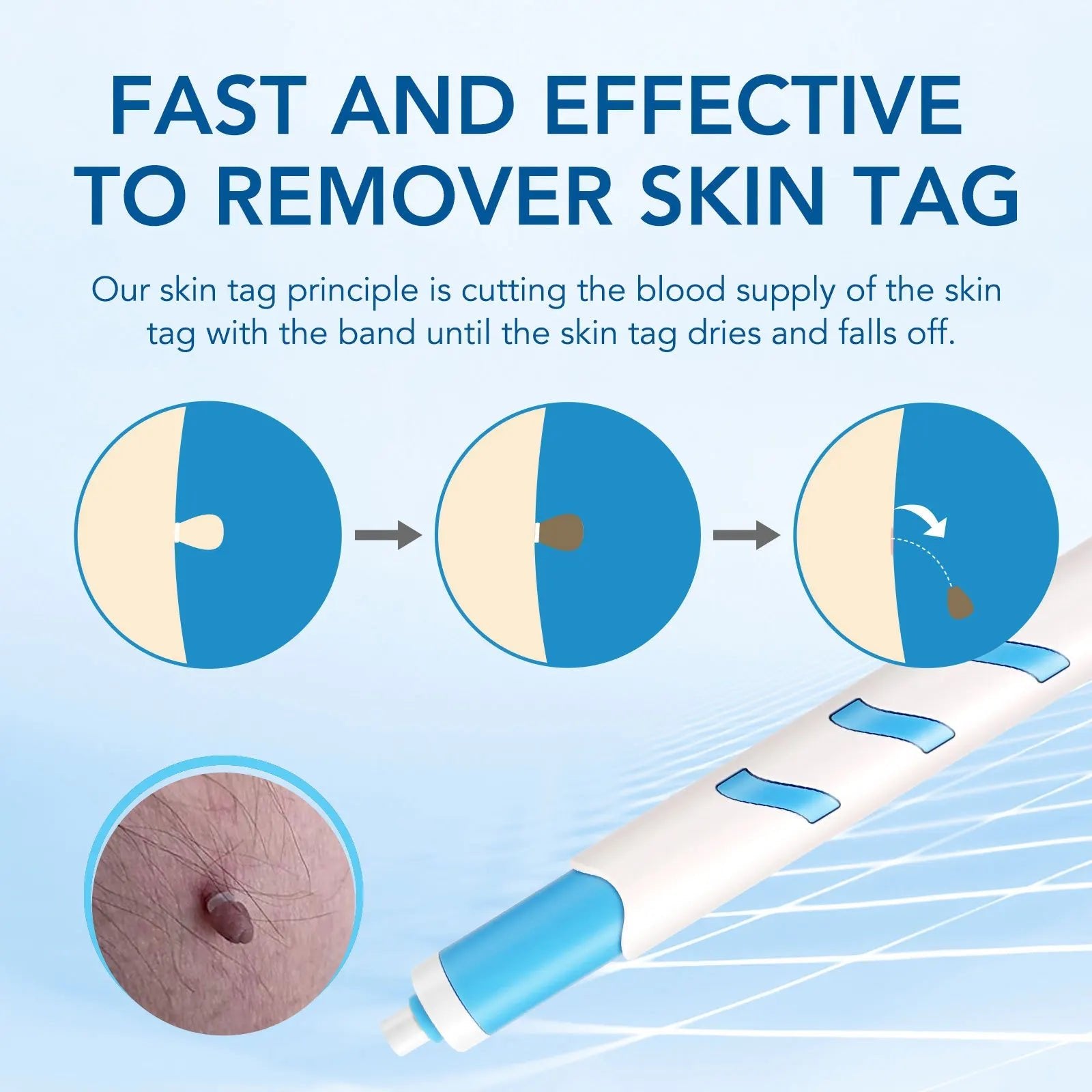 Home Use Painless Safe Skin Tag Mole Wart Spot Removal Equipment for Smooth Skin Wart Remover Eyelid Lifting Acne Treatment Pen - Ammpoure