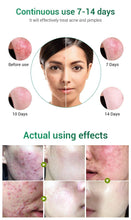 Load image into Gallery viewer, 72 Pimple Acne Patches - Ammpoure London
